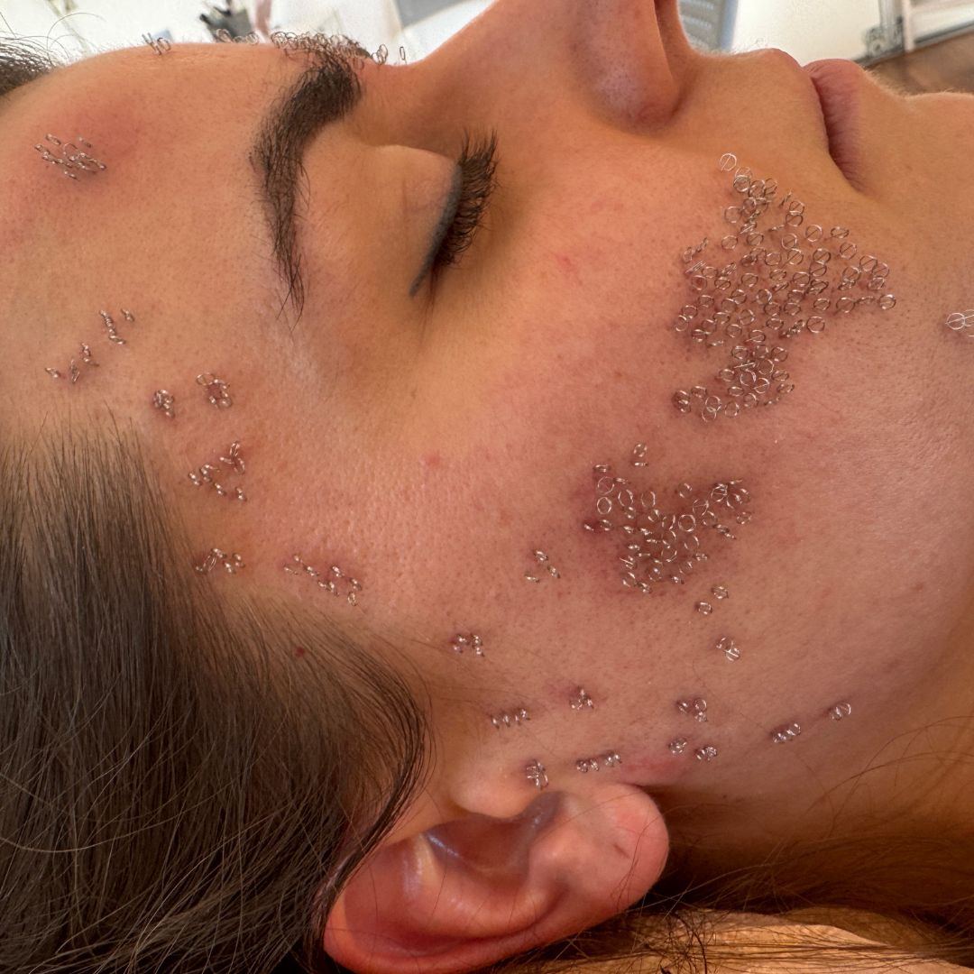 pinezkowanie blizn potrądzikowych